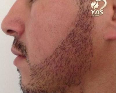 عکس قبل و بعد کاشت ریش و سبیل
