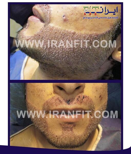 عکس قبل و بعد کاشت ریش و سبیل