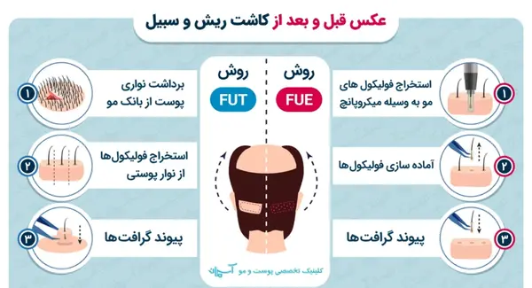 عکس قبل و بعد کاشت ریش و سبیل