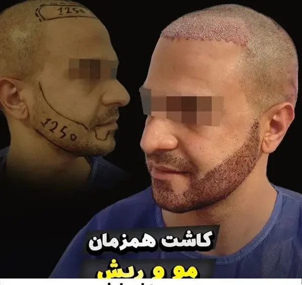 عکس قبل و بعد کاشت ریش و سبیل