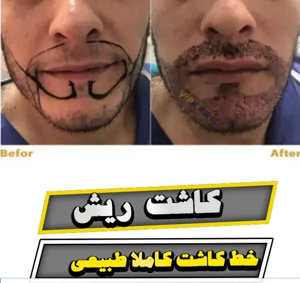 عکس قبل و بعد کاشت ریش و سبیل