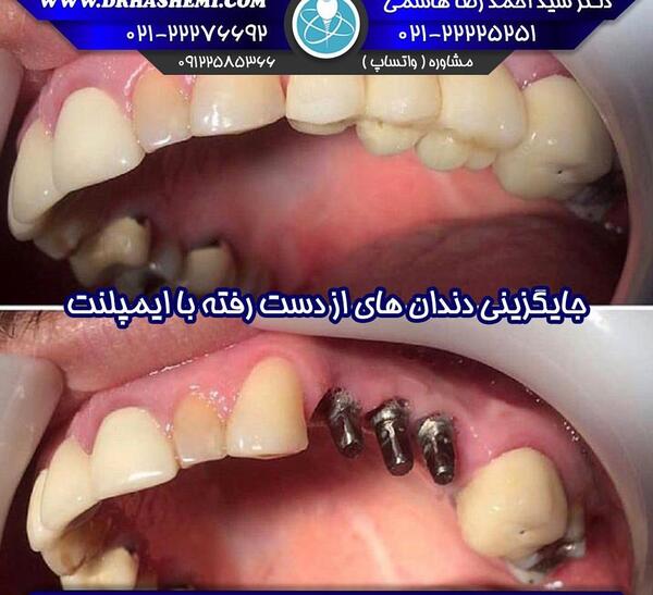 عکس کاشت دندان طبیعی