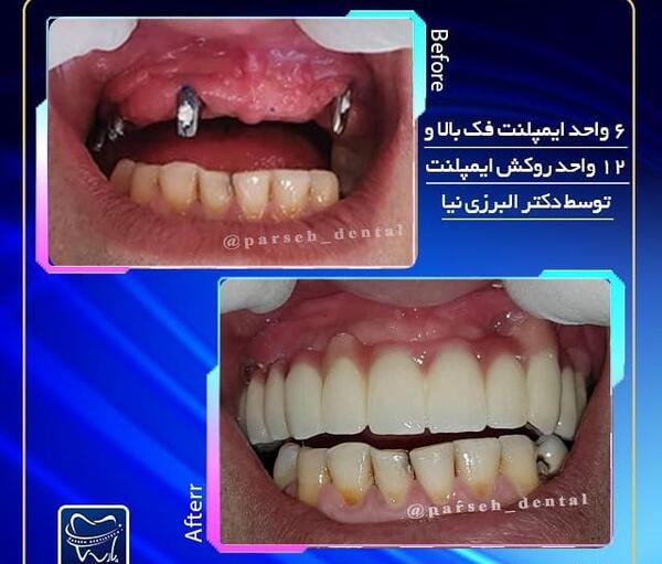 عکس کاشت دندان طبیعی