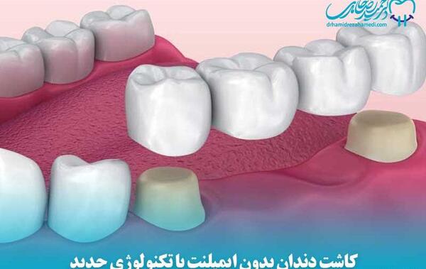 عکس کاشت دندان طبیعی