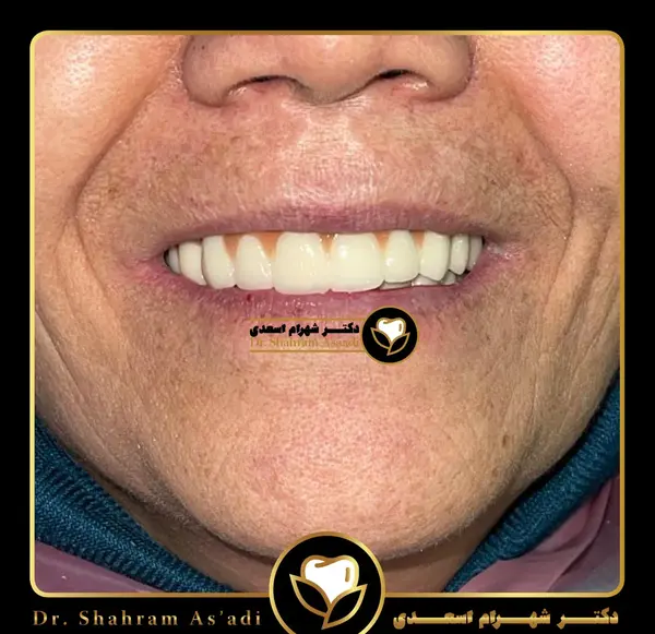 عکس کاشت دندان طبیعی