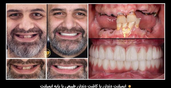 عکس کاشت دندان طبیعی