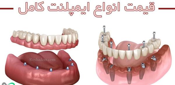 عکس کاشت دندان طبیعی