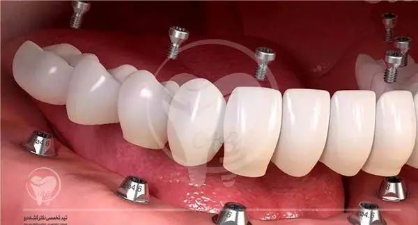 عکس کاشت دندان طبیعی