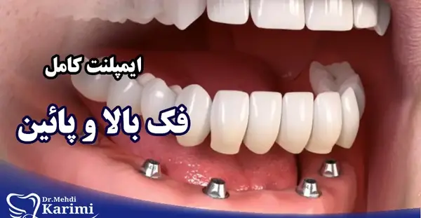 عکس کاشت دندان طبیعی