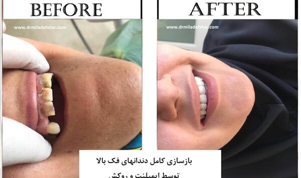 عکس کاشت دندان طبیعی