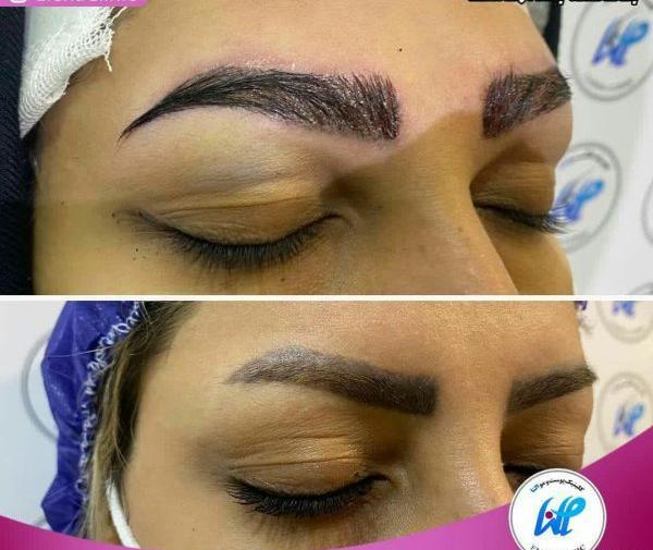 عکس کاشت مژه نی نی سایت