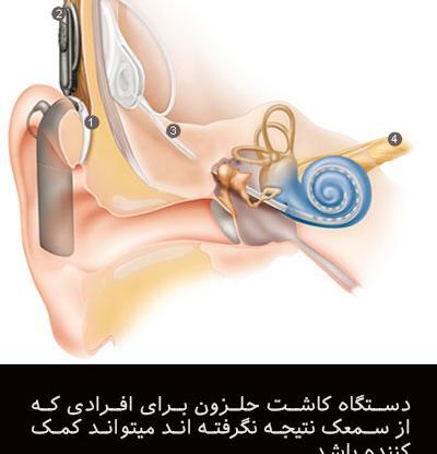 عکس دستگاه کاشت حلزون