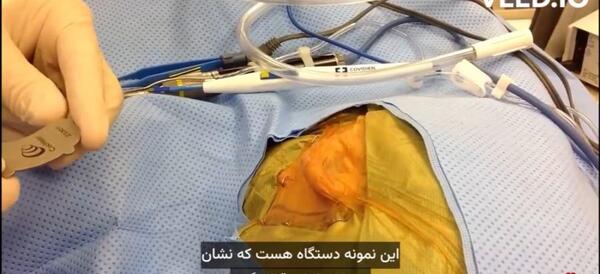 عکس دستگاه کاشت حلزون