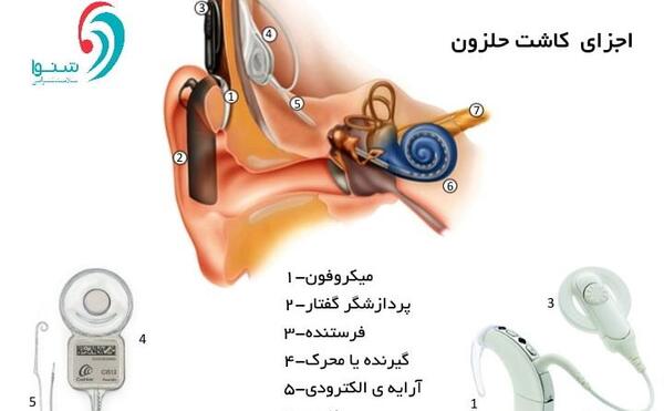 عکس سمعک کاشت حلزون