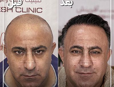 عکس کاشت مو بعد از ده روز