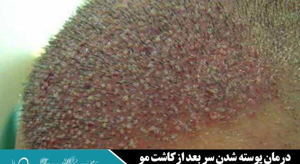 عکس کاشت مو بعد از ده روز