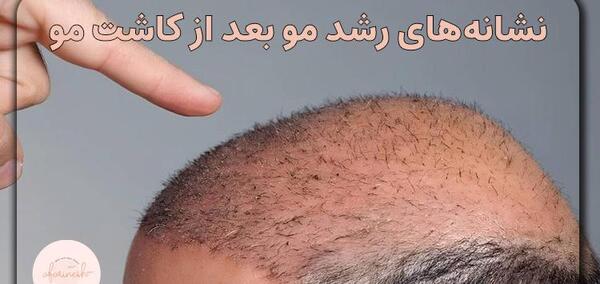 عکس کاشت مو بعد از ده روز