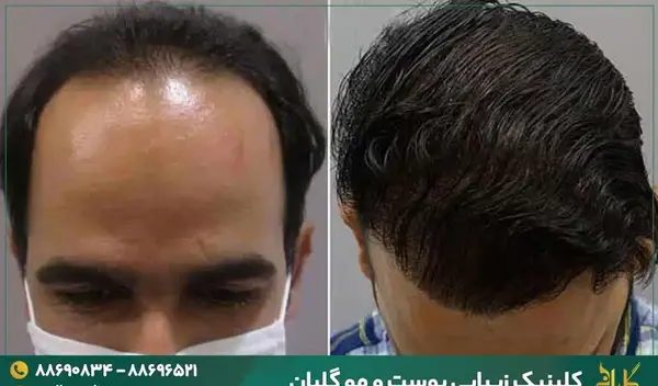 عکس کاشت مو بعد از ده روز