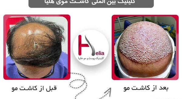 عکس کاشت مو بعد از ده روز