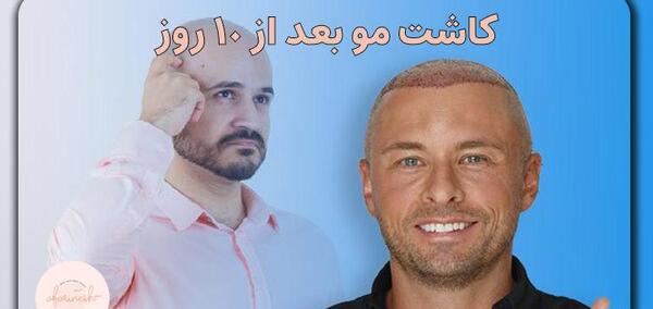عکس کاشت مو بعد از ده روز