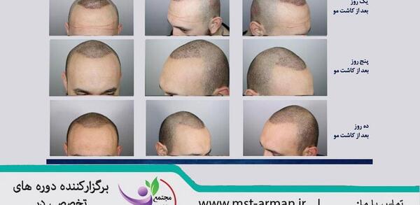 عکس کاشت مو بعد از ده روز