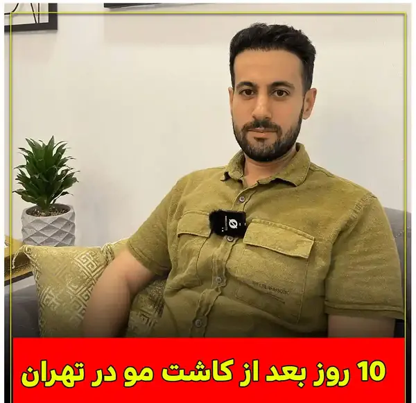 عکس کاشت مو بعد از ده روز