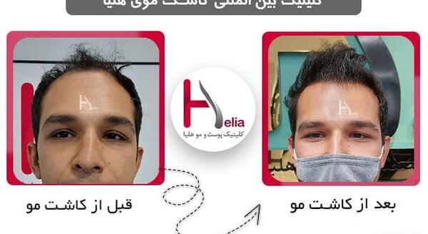 عکس کاشت مو بعد از ده روز