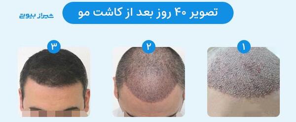 عکس کاشت مو بعد از ده روز