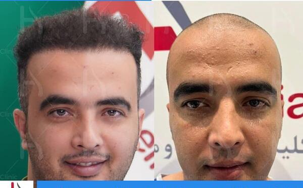 عکس کاشت مو بعد از ده روز