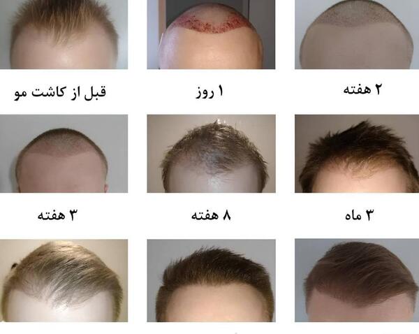 عکس کاشت مو بعد از ده روز