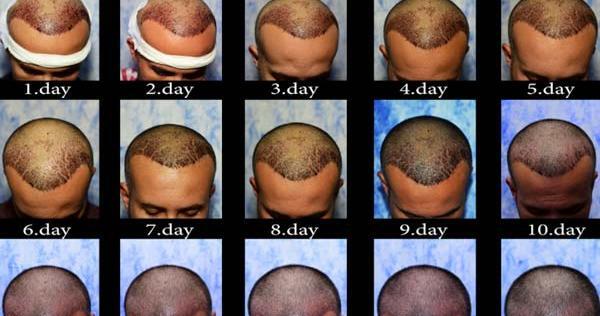 عکس کاشت مو بعد از ده روز