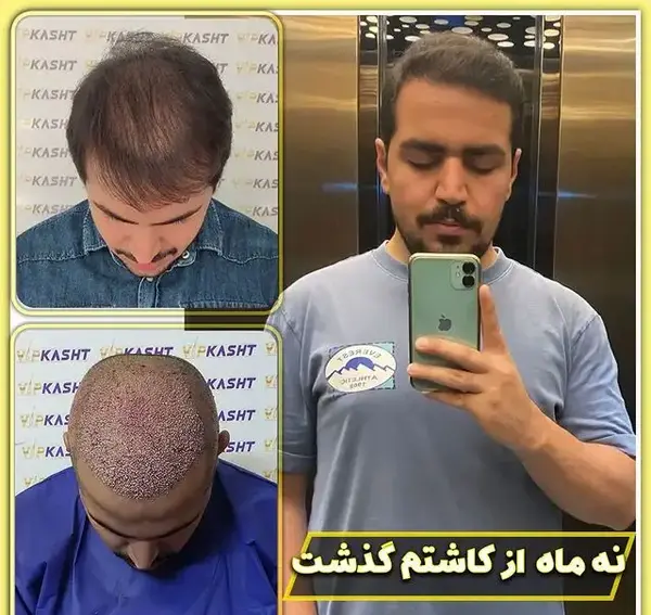 عکس کاشت مو بعد از شش ماه