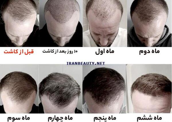 عکس کاشت مو بعد از شش ماه