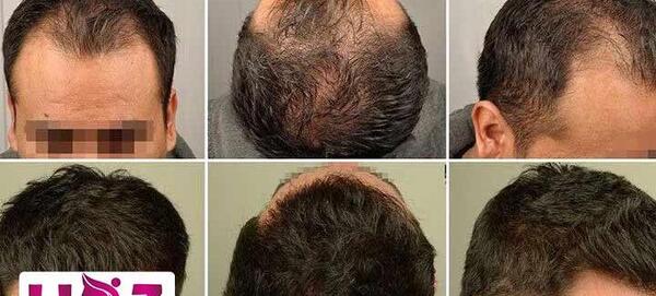 عکس کاشت مو بعد از شش ماه