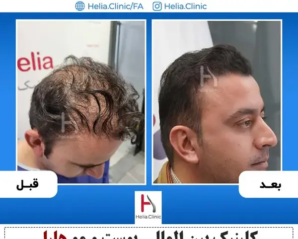 عکس کاشت مو بعد از شش ماه