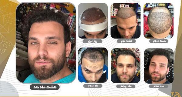 عکس کاشت مو بعد از شش ماه