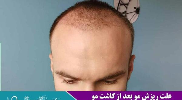 عکس کاشت مو بعد از شش ماه