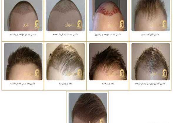 عکس کاشت مو بعد از شش ماه