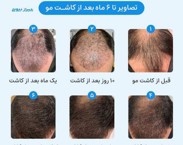 عکس کاشت مو بعد از شش ماه