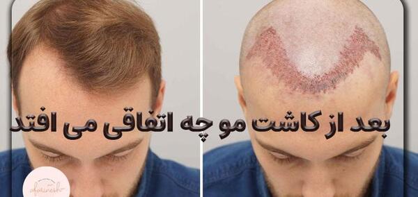 عکس کاشت مو بعد از شش ماه