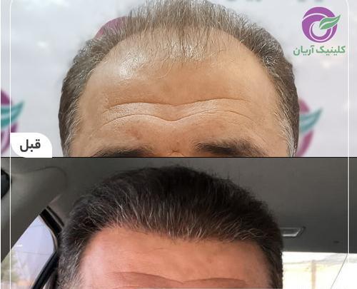 عکس کاشت مو تازه
