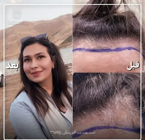 عکس کاشت مو تازه