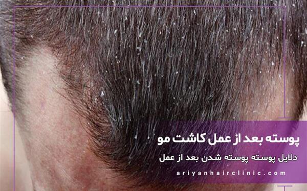عکس کاشت مو تازه