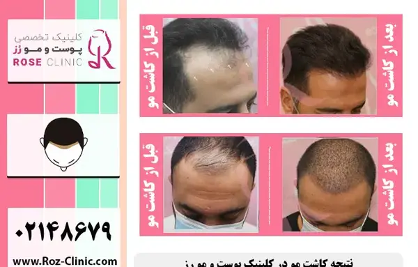 عکس کاشت مو تازه