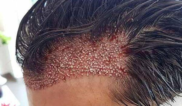 عکس کاشت مو تازه