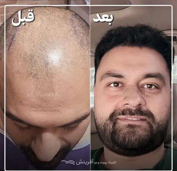 عکس کاشت مو با تراکم بالا