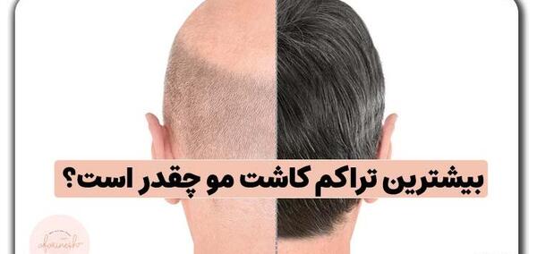 عکس کاشت مو با تراکم بالا