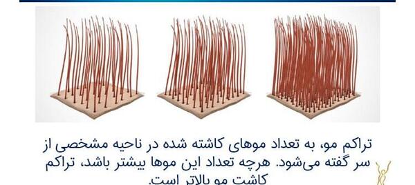 عکس کاشت مو با تراکم بالا