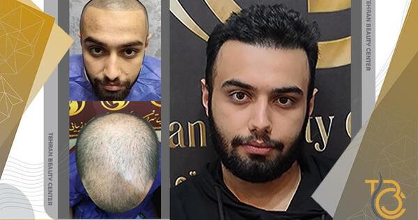 عکس کاشت مو با تراکم بالا