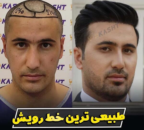 عکس کاشت مو با تراکم بالا